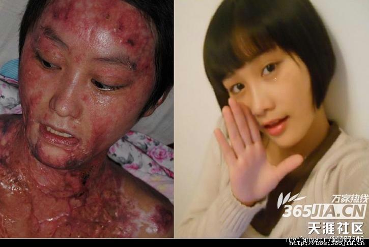 高清:合肥17岁少女拒绝官二代求爱后惨遭泼油毁容-新闻频道-和讯网