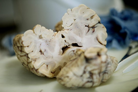 揭秘大脑解剖全过程:苍白血管清晰可见(图)-读